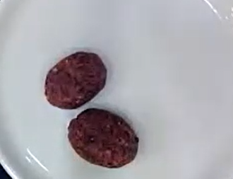 Banana Beetroot Cutlet: